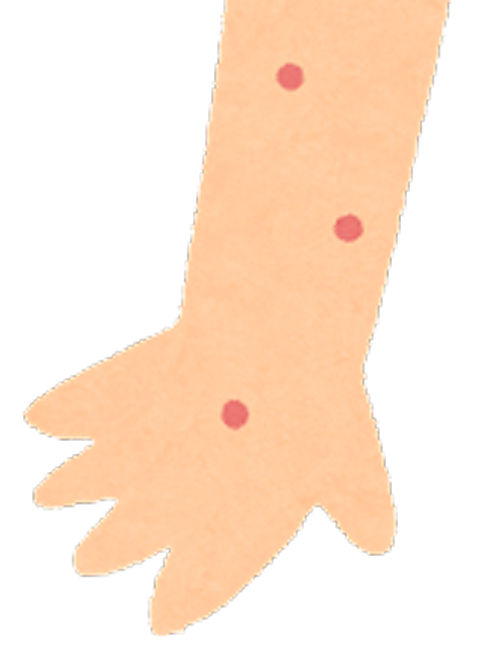 乾癬・掌蹠膿疱症・異汗性湿疹